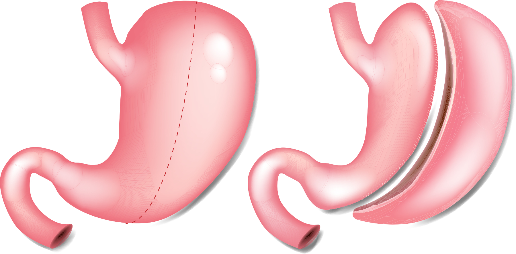 Définition Gastrectomie Sleeve gastrectomie